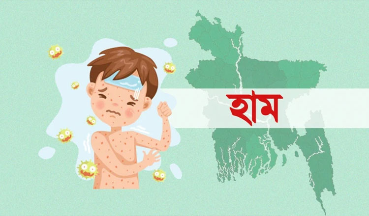 ৭৭ দিনে হাম ও উপসর্গে ৫৮৫ শিশুর মৃত্যু