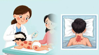 হাম ও উপসর্গে আরও ৮ শিশুর মৃত্যু